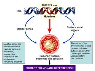 Pulmonary Hypertension | PDF
