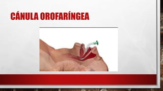 CÁNULA OROFARÍNGEA
 