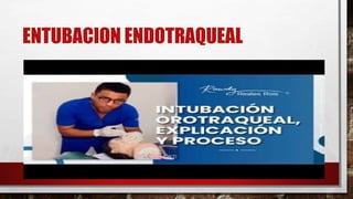 ENTUBACION ENDOTRAQUEAL
 