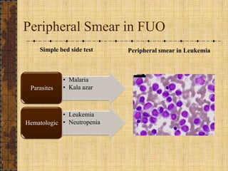 Peripheral Smear in FUOSimple bed side testPeripheral smear in Leukemia