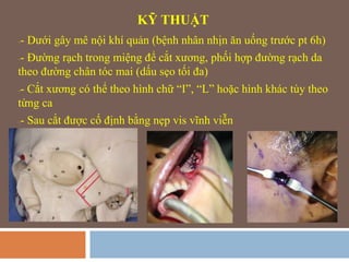 Phẫu thuật tạo hình gò má | PPTX