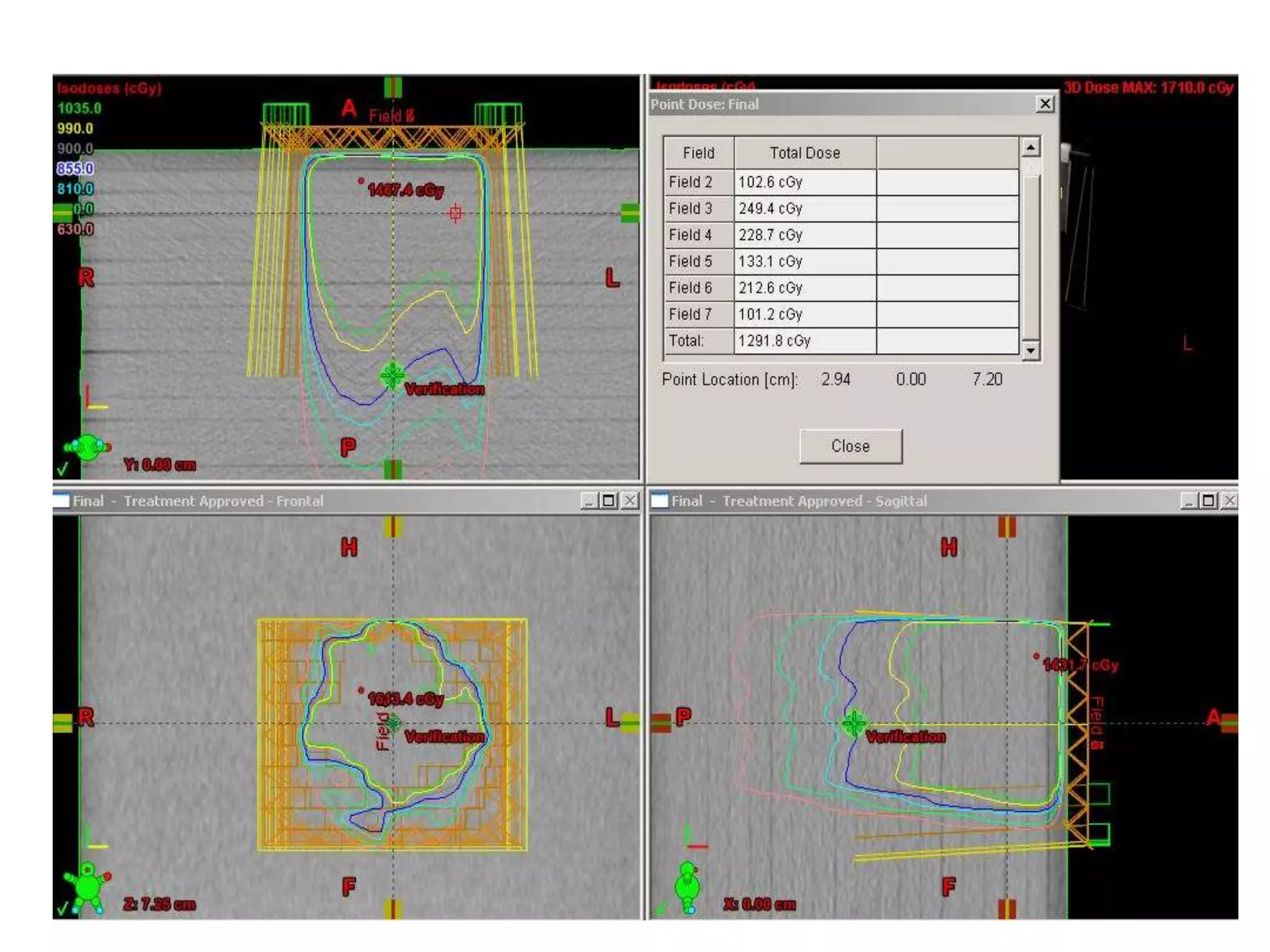 Three dimensional conformal radiotherapy - 3D-CRT and IMRT - Intensity ...