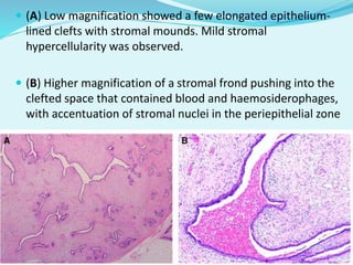  (A) Low magnification showed a few elongated epithelium-
lined clefts with stromal mounds. Mild stromal
hypercellularity was observed.
 (B) Higher magnification of a stromal frond pushing into the
clefted space that contained blood and haemosiderophages,
with accentuation of stromal nuclei in the periepithelial zone
 