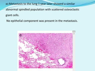 (C) Metastasis to the lung 1 year later showed a similar
abnormal spindled population with scattered osteoclastic
giant cells.
No epithelial component was present in the metastasis.
 