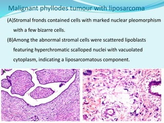 Malignant phyllodes tumour with liposarcoma
(A)Stromal fronds contained cells with marked nuclear pleomorphism
with a few bizarre cells.
(B)Among the abnormal stromal cells were scattered lipoblasts
featuring hyperchromatic scalloped nuclei with vacuolated
cytoplasm, indicating a liposarcomatous component.
 