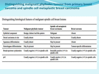 Distinguishing malignant phyllodes tumour from primary breast
sarcoma and spindle cell metaplastic breast carcinoma
 