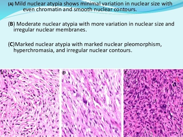Phyllodes Tumour