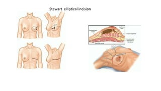 phyllodes tumour final presentation of breast | PPTX