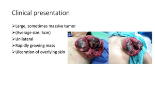 Clinical presentation
Large, sometimes massive tumor
(Average size: 5cm)
Unilateral
Rapidly growing mass
Ulceration of overlying skin
 