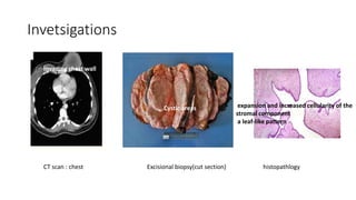 Invetsigations
CT scan : chest Excisional biopsy(cut section) histopathlogy
Invading chest wall
Cystic areas expansion and increased cellularity of the
stromal component
a leaf-like pattern
 