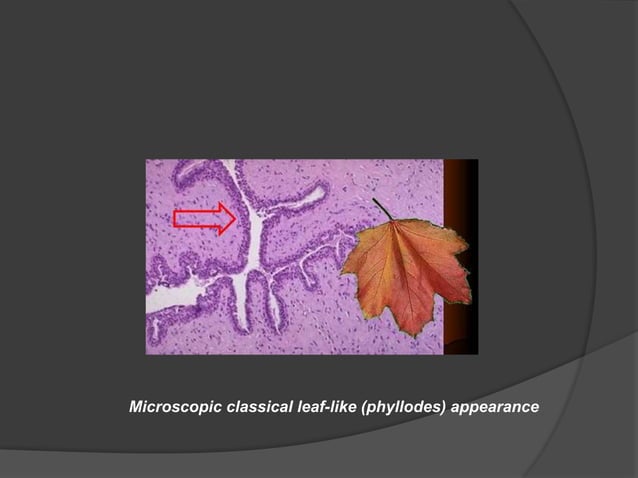 PHYLLOIDES TUMOUR.pptx | Cancer | Diseases and Conditions