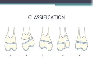 CLASSIFICATION 
 