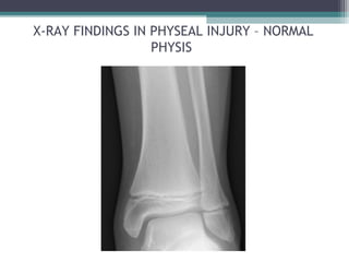 X-RAY FINDINGS IN PHYSEAL INJURY – NORMAL 
PHYSIS 
 