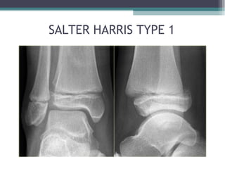 SALTER HARRIS TYPE 1 
 