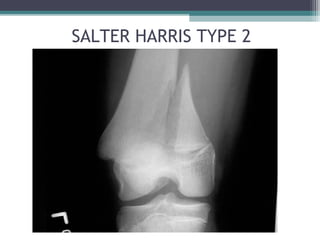 SALTER HARRIS TYPE 2 
 