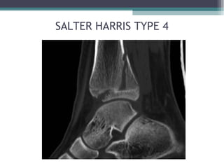 SALTER HARRIS TYPE 4 
 