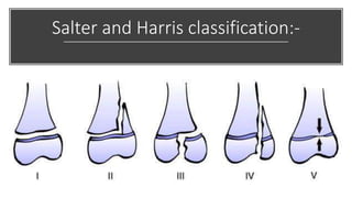 Salter and Harris classification:-
 