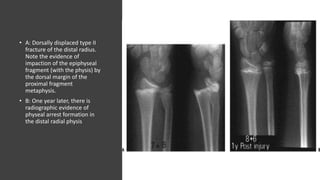 • A: Dorsally displaced type II
fracture of the distal radius.
Note the evidence of
impaction of the epiphyseal
fragment (with the physis) by
the dorsal margin of the
proximal fragment
metaphysis.
• B: One year later, there is
radiographic evidence of
physeal arrest formation in
the distal radial physis
 