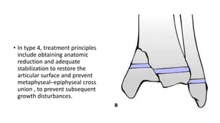 • In type 4, treatment principles
include obtaining anatomic
reduction and adequate
stabilization to restore the
articular surface and prevent
metaphyseal–epiphyseal cross
union , to prevent subsequent
growth disturbances.
 