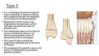 Type 5
• It is a relatively uncommon type of
injury caused by a severe crushing
force applied through the epiphysis
to one area of the physeal plate.
• Mechanism of this injury is by
longitudinal compression, which
damages the germinal layer of
physeal cells.
• The radiograph taken at the time of
injury is normal (as there is no
fracture) and growth-arrest is
discovered only in retrospect.
• This type of injury cannot be
diagnosed radiologically at the time
of trauma.
• The prognosis for growth is poor, and
there is a likelihood of premature
growth cessation
 