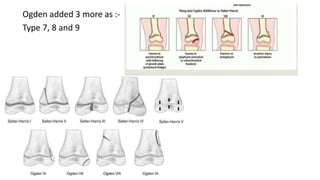 Ogden added 3 more as :-
Type 7, 8 and 9
 