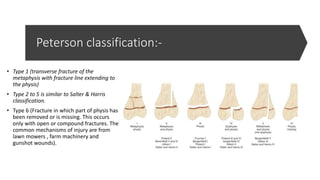 Peterson classification:-
• Type 1 (transverse fracture of the
metaphysis with fracture line extending to
the physis)
• Type 2 to 5 is similar to Salter & Harris
classification.
• Type 6 (Fracture in which part of physis has
been removed or is missing. This occurs
only with open or compound fractures. The
common mechanisms of injury are from
lawn mowers , farm machinery and
gunshot wounds).
 