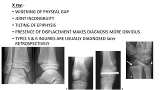 X ray:-
• WIDENING OF PHYSEAL GAP
• JOINT INCONGRUITY
• TILTING OF EPIPHYSIS
• PRESENCE OF DISPLACEMENT MAKES DIAGNOSIS MORE OBVIOUS
• TYPES 5 & 6 INJURIES ARE USUALLY DIAGNOSED later
RETROSPECTIVELY
 