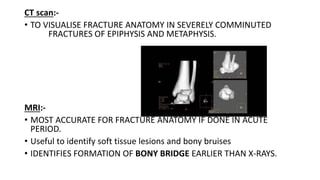 CT scan:-
• TO VISUALISE FRACTURE ANATOMY IN SEVERELY COMMINUTED
FRACTURES OF EPIPHYSIS AND METAPHYSIS.
MRI:-
• MOST ACCURATE FOR FRACTURE ANATOMY IF DONE IN ACUTE
PERIOD.
• Useful to identify soft tissue lesions and bony bruises
• IDENTIFIES FORMATION OF BONY BRIDGE EARLIER THAN X-RAYS.
 