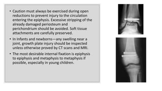 • Caution must always be exercised during open
reductions to prevent injury to the circulation
entering the epiphysis. Excessive stripping of the
already damaged periosteum and
perichondrium should be avoided. Soft tissue
attachments are carefully preserved.
• In Infants and newborns—any swelling near a
joint, growth plate injury should be inspected
unless otherwise proved by CT scans and MRI.
• The most desirable internal fixation is epiphysis
to epiphysis and metaphysis to metaphysis if
possible, especially in young children.
 