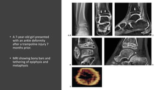 • A 7-year-old girl presented
with an ankle deformity
after a trampoline injury 7
months prior.
• MRI showing bony bars and
tethering of epiphysis and
metaphysis
 
