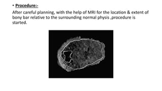 • Procedure:-
After careful planning, with the help of MRI for the location & extent of
bony bar relative to the surrounding normal physis ,procedure is
started.
 