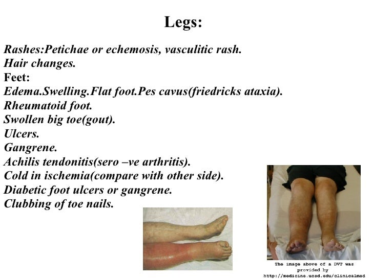 Swollen Legs Liver Failure carfare.me 20192020