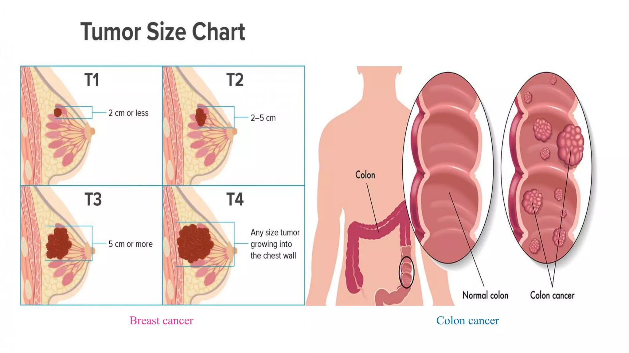 Breast cancer Colon cancer
 