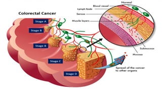 Physical activity and cancer | PDF