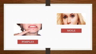 PIMPLES
MOLE
 