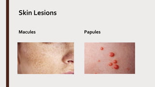 Skin Lesions
Macules Papules
 
