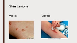 Skin Lesions
Vesicles Wounds
 