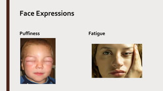 Face Expressions
Puffiness Fatigue
 