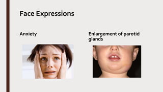 Face Expressions
Anxiety Enlargement of parotid
glands
 