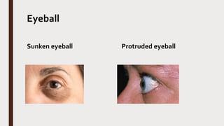 Eyeball
Sunken eyeball Protruded eyeball
 