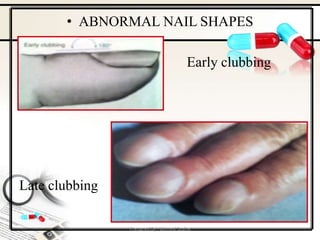 Nail Clubbing Algorithm Health Assessment / Physical assessment.pptx