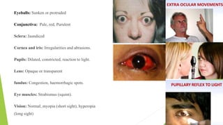 Eyeballs: Sunken or protruded
Conjunctiva: Pale, red, Purulent
Sclera: Jaundiced
Cornea and iris: Irregularities and abrasions.
Pupils: Dilated, constricted, reaction to light.
Lens: Opaque or transparent
fundus: Congestion, haemorrhagic spots.
Eye muscles: Strabismus (squint).
Vision: Normal, myopia (short sight), hyperopia
(long sight)
 
