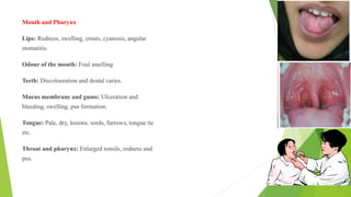 Mouth and Pharynx
Lips: Redness, swelling, crusts, cyanosis, angular
stomatitis.
Odour of the mouth: Foul smelling
Teeth: Discolouration and dental caries.
Mucus membrane and gums: Ulceration and
bleeding, swelling, pus formation.
Tongue: Pale, dry, lesions, sords, furrows, tongue tie
etc.
Throat and pharynx: Enlarged tonsils, redness and
pus.
 