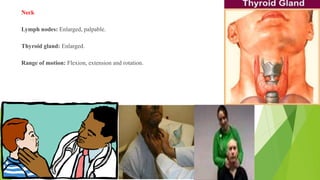 Neck
Lymph nodes: Enlarged, palpable.
Thyroid gland: Enlarged.
Range of motion: Flexion, extension and rotation.
 
