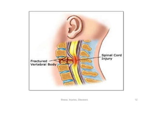 Physical Disabilities Types PHYSICAL DISABILITY | PPTX