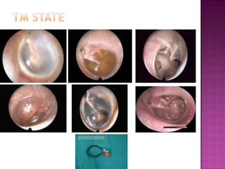 OtoscopyExternal ear