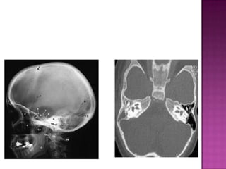 InvestigationsAudiometric Tests: Includes: 1. Pure – tone Audiometry (PTA) which is most commonly used used for measuring hearing acuity. 2. Tympanometry which provides a quick objective measurement of the state of the middle ear.