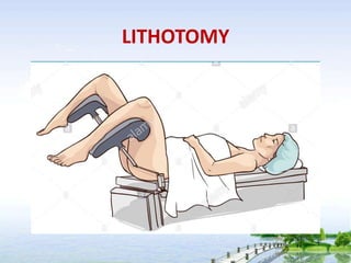 LITHOTOMY
 