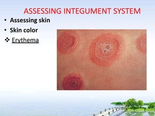 ASSESSING INTEGUMENT SYSTEM
• Assessing skin
• Skin color
 Erythema
 
