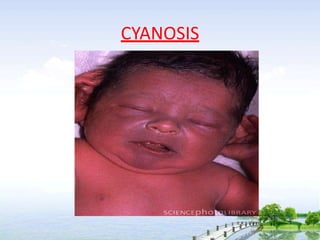 CYANOSIS
 